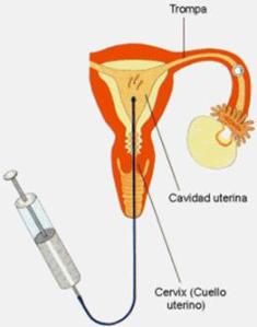 Inseminación intrauterina